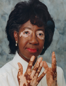 A woman who suffers from Vitiligo