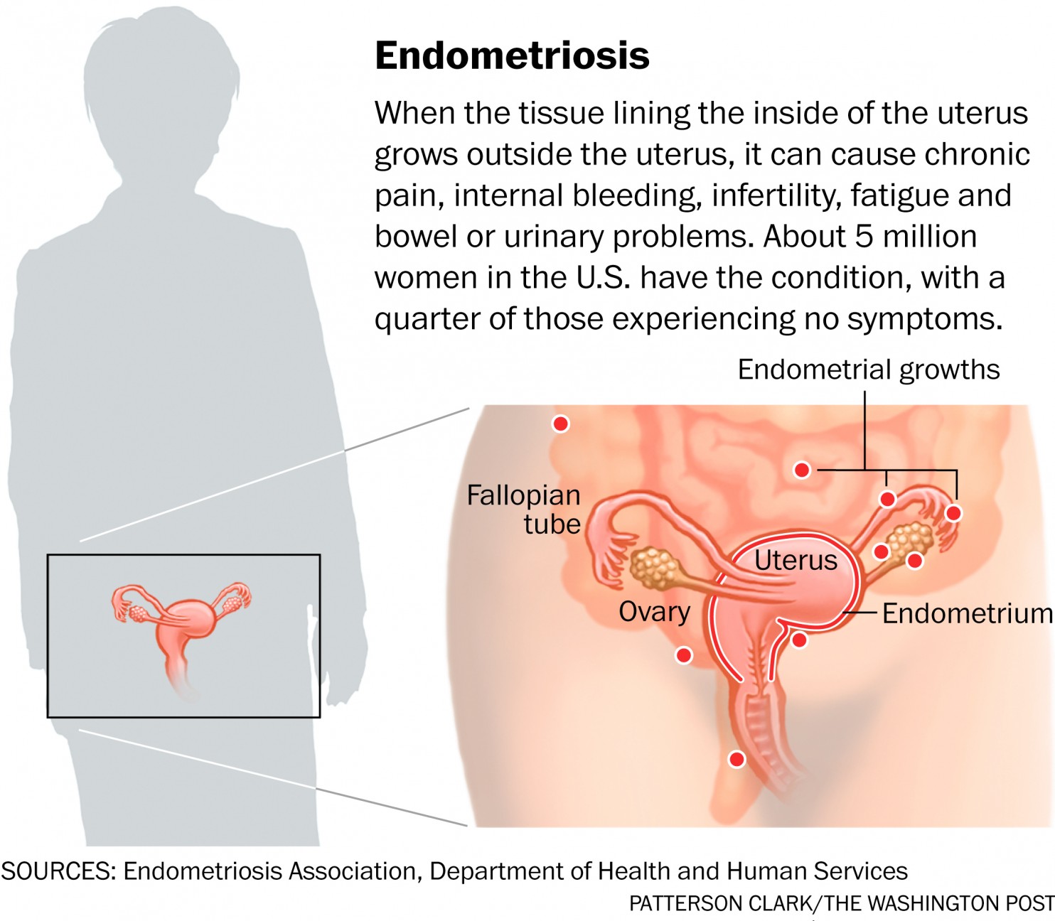 Photo from https://www.washingtonpost.com/national/health-science/for-women-with-endometriosis-answers-are-few/2015/05/04/c925edf2-c737-11e4-aa1a-86135599fb0f_story.html