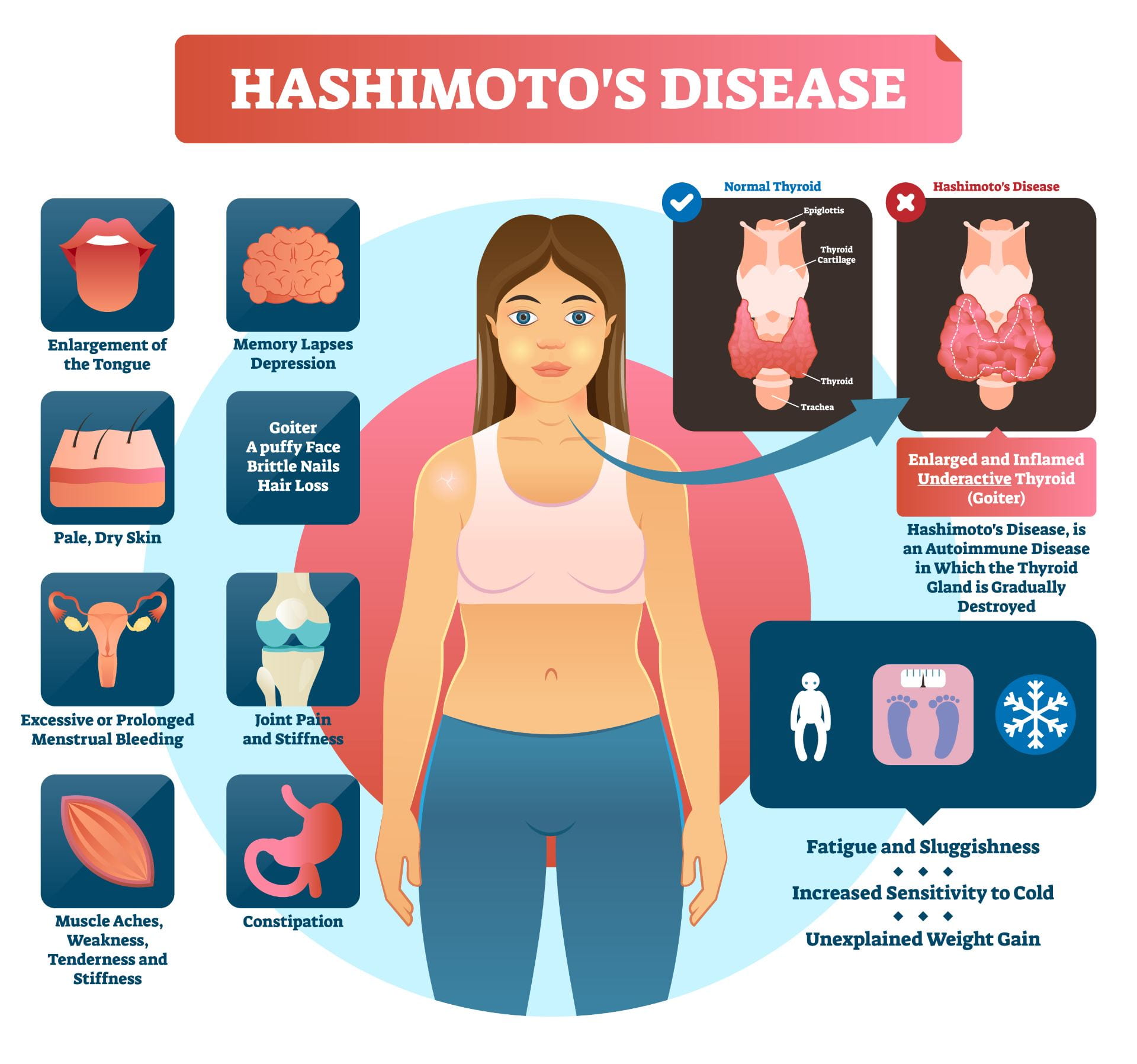 new research hashimoto's thyroiditis