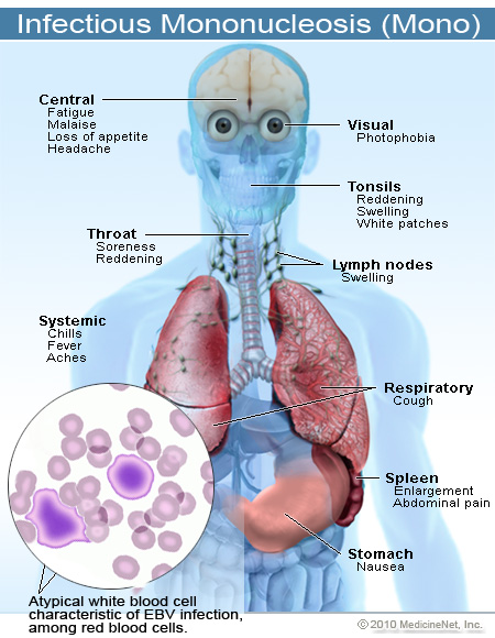 Infectious mononucleosis: Symptoms, causes, diagnosis and treatments