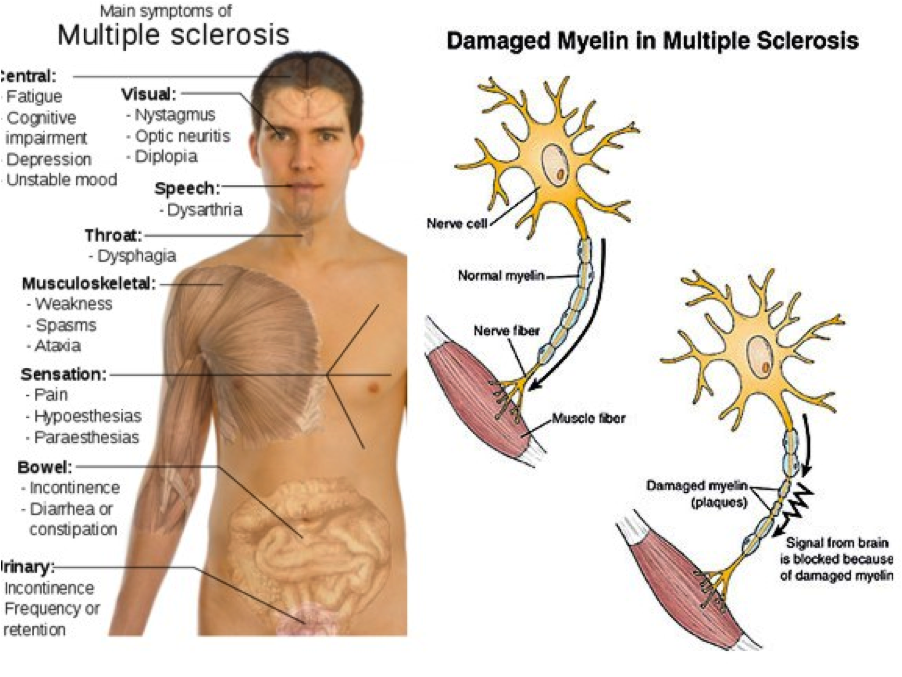 case study on multiple sclerosis